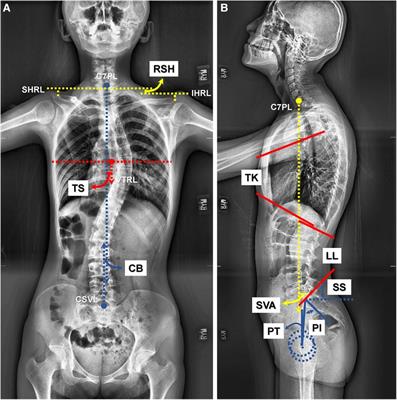 Radiographic and clinical outcomes of robot-assisted pedicle screw instrumentation for adolescent idiopathic scoliosis